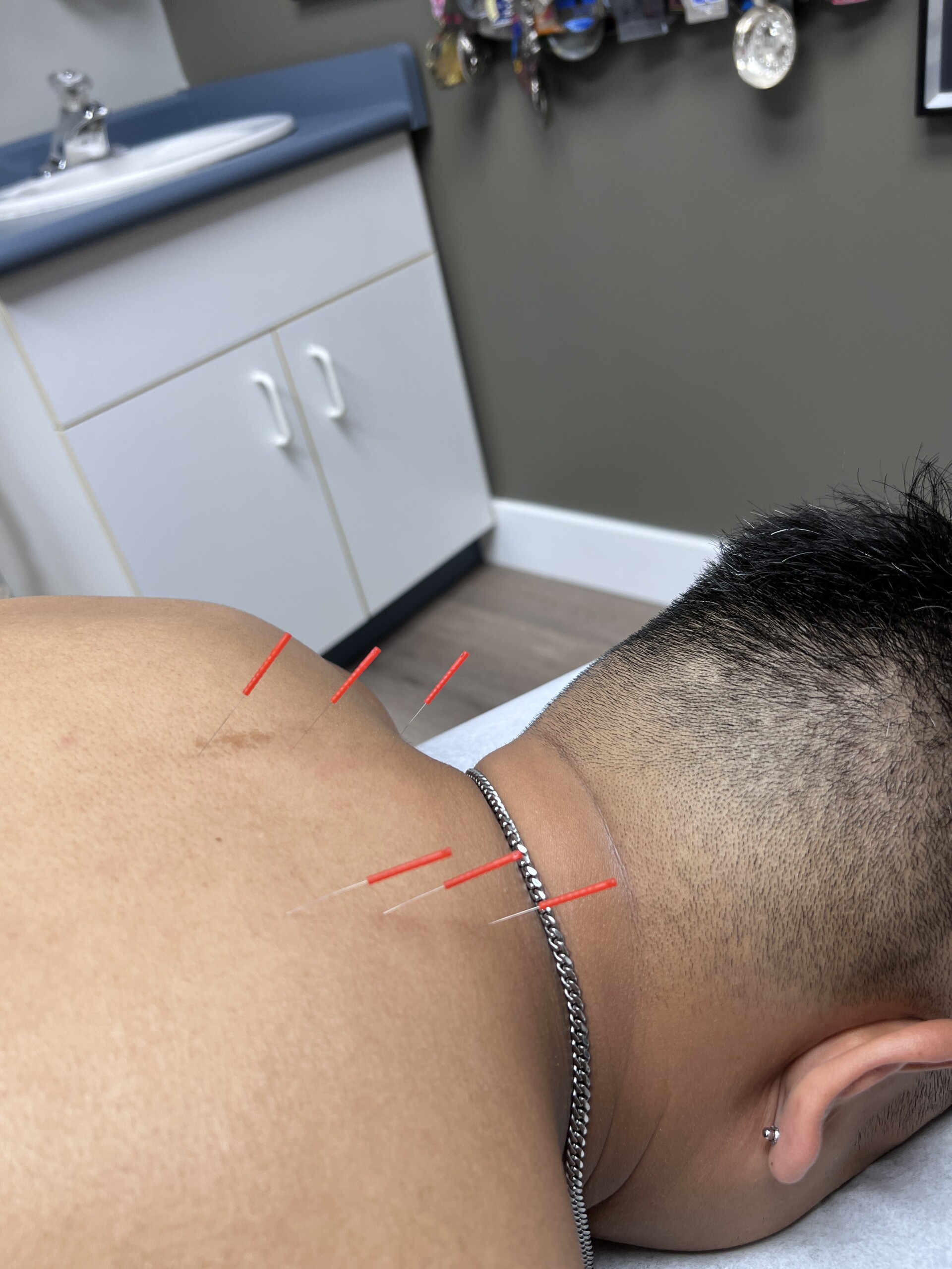 man receiving acupuncture on his upper back